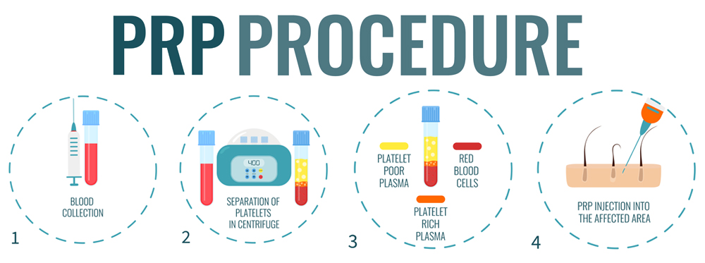 prp-procedure